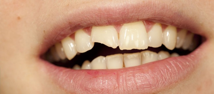 broken tooth