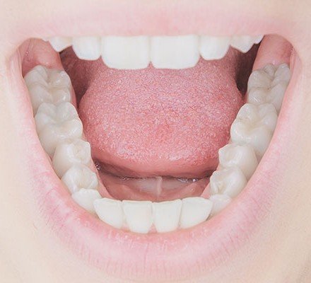 composite fillings
