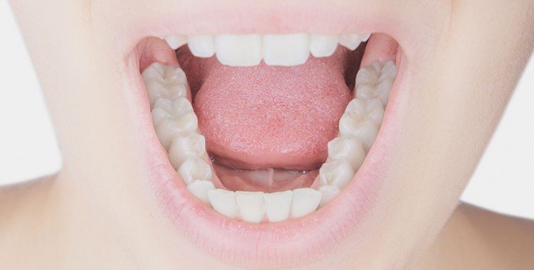composite fillings
