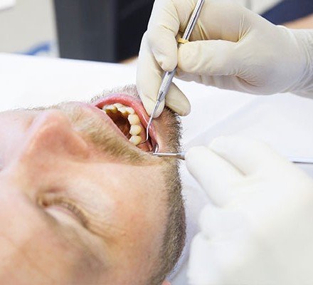 root canal treatment