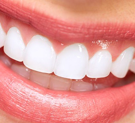veneers