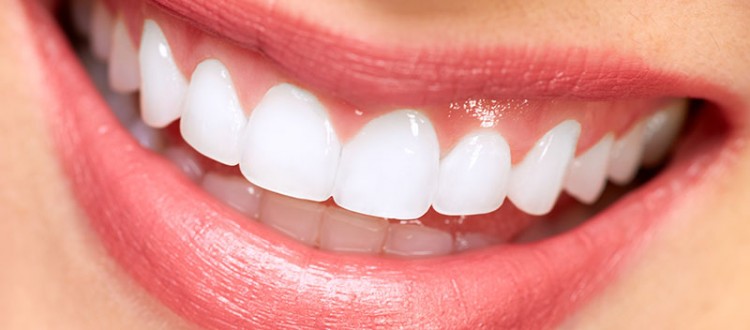 veneers